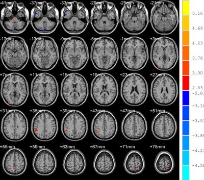 The Effect of Abnormal Regional Homogeneity and Spontaneous Low-Frequency Brain Activity on Lower Cognitive Ability: A Cross-Sectional Study on Postoperative Children With Tetralogy of Fallot